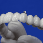 Protesi Dentale Circolare dautore in ceramica 14 denti 2